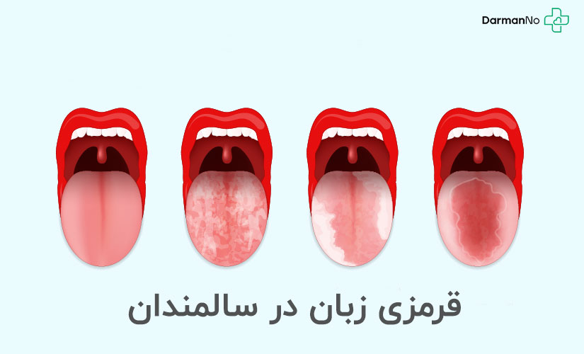 علت قرمزی زبان در سالمندان
