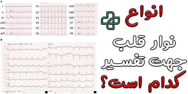 انواع نوار قلب جهت تفسیر چند نوع است؟