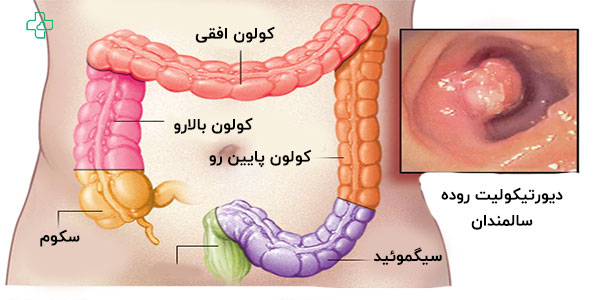 بیماری دیورتیکولیت در سالمندان