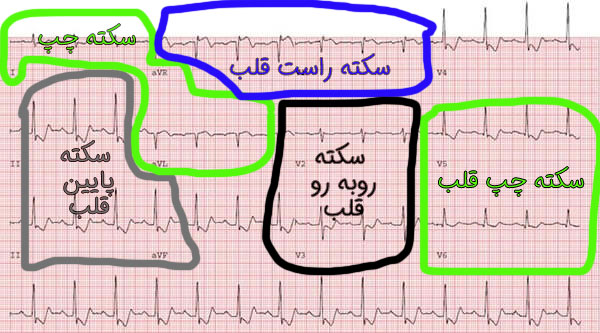 تغییرات نوار قلب در سکته قلبی