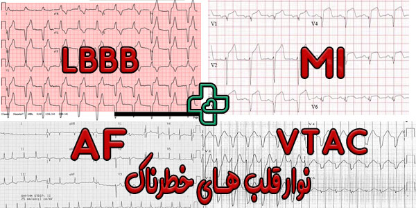 عکس نوار قلب نامنظم