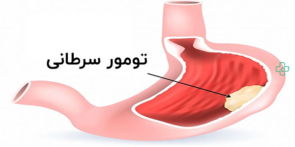 مهم ترین علائم سرطان معده به چه صورتی است؟