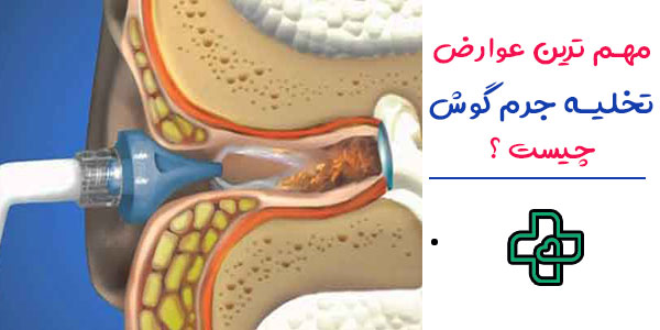 مهم ترین عوارض تخلیه جرم گوش