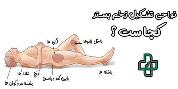 نواحی تشکیل زخم بستر کجاست؟