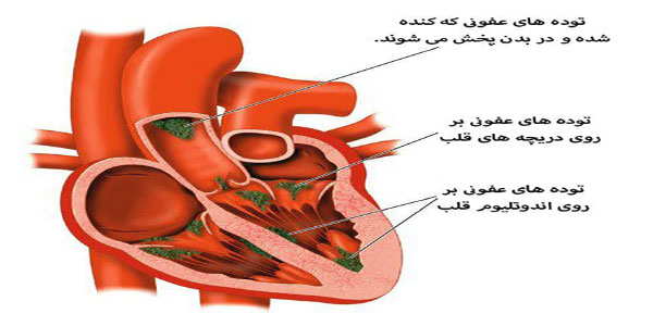 نوار قلب در عفونت های قلبی