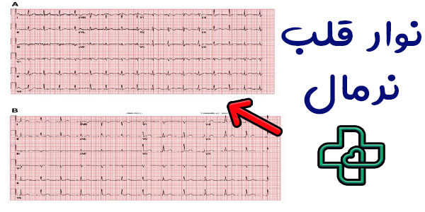 نوار قلب نرمال