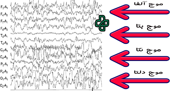 چه موج هایی پس از گرفتن نوار مغز در منزل قابل تفسیر است؟