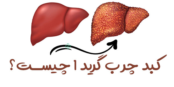 کبد چرب گرید 1 چیست؟