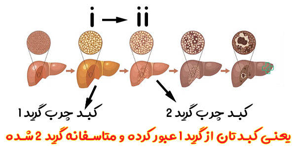 کبد چرب گرید i-ii یعنی چه